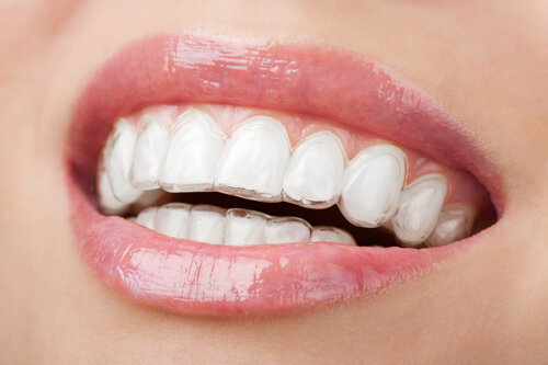 Teeth Whitening Ventura