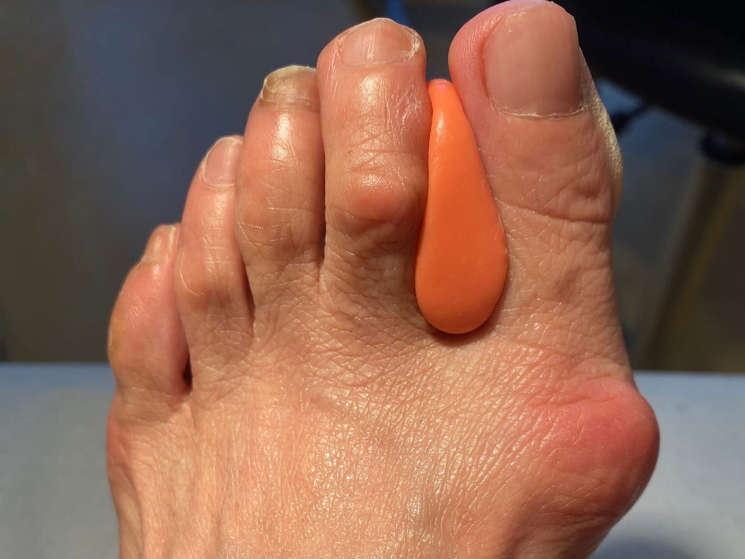 Hallux Valgus