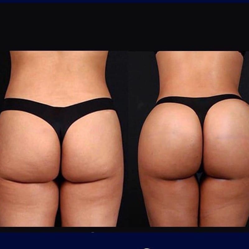 מילוי שומן בישבן