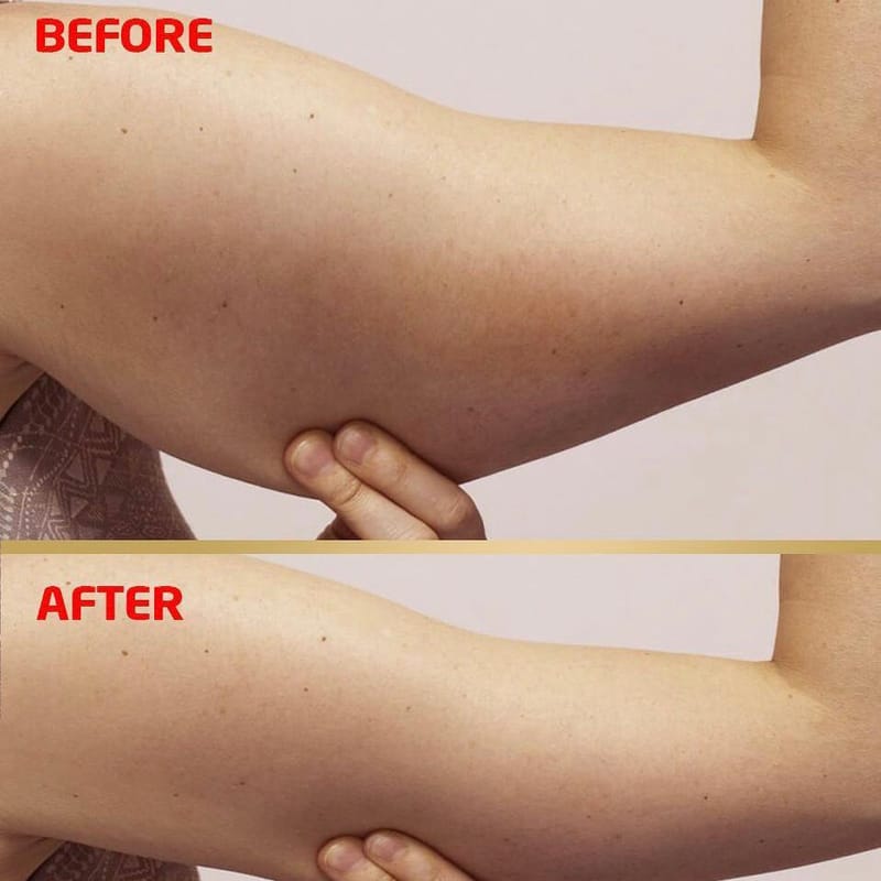 מתיחת זרועות הינו אחד הניתוחים הנפוצים בעולם ההופך את הזרועות למוצקות מחוטבות ודקיקות יותר לשיפור המראה האסתטי והעלאת הבטחון העצמי.