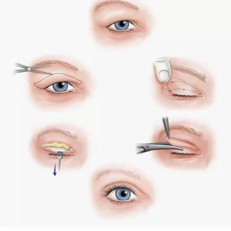 ניתוח עפעפיים