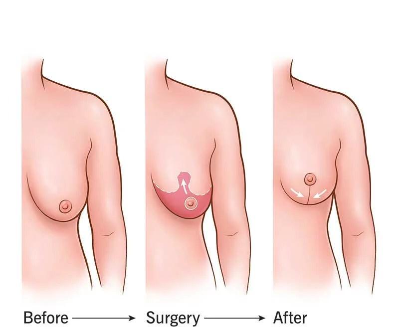 הגדלת/ הקטנת חזה
