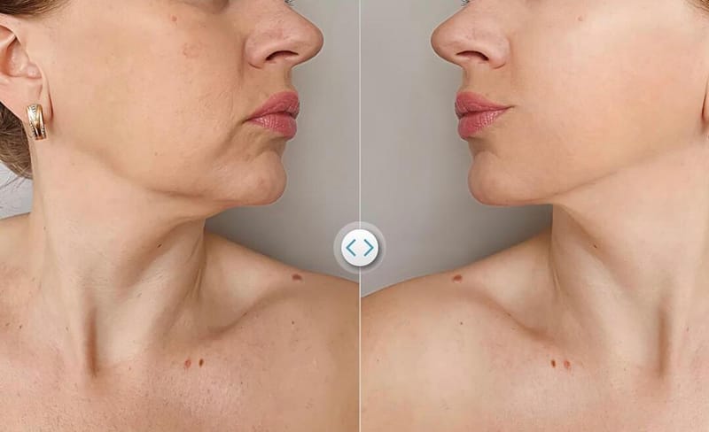 שאיבת שומן מהסנטר