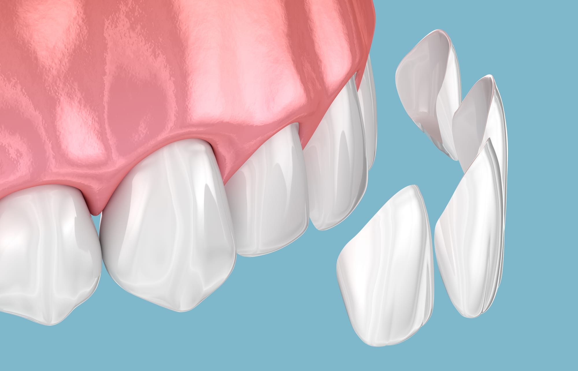 The Magic of Dental Veneers: A Complete Overview
