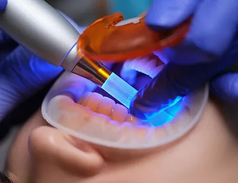 Dental Fillings