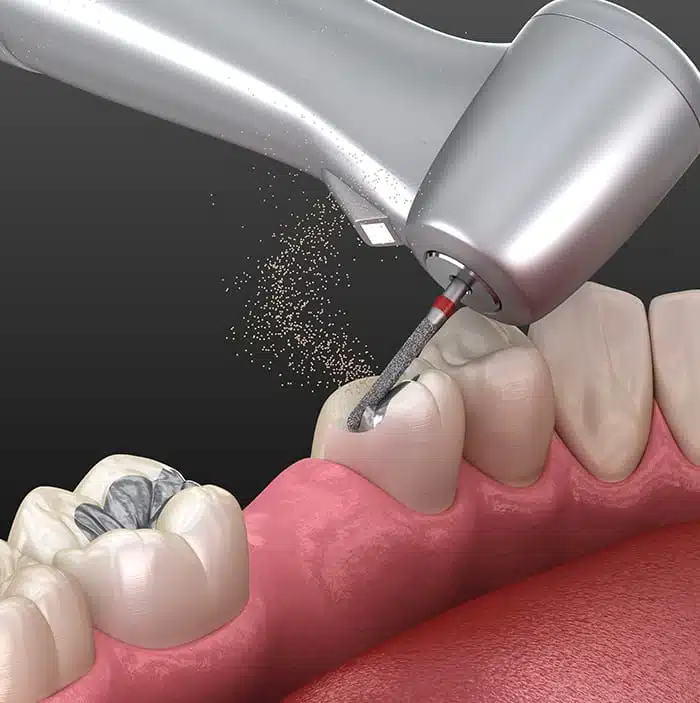 Safe Amalgam Removal