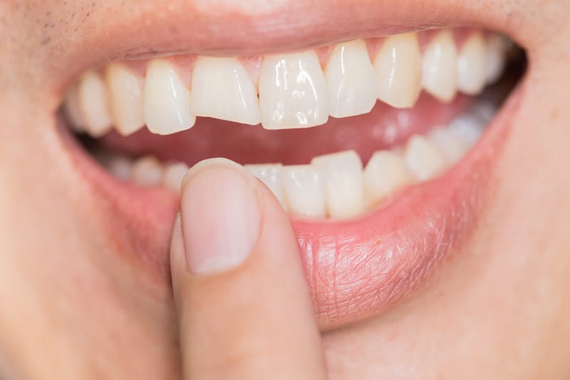 Broken or Chipped Teeth