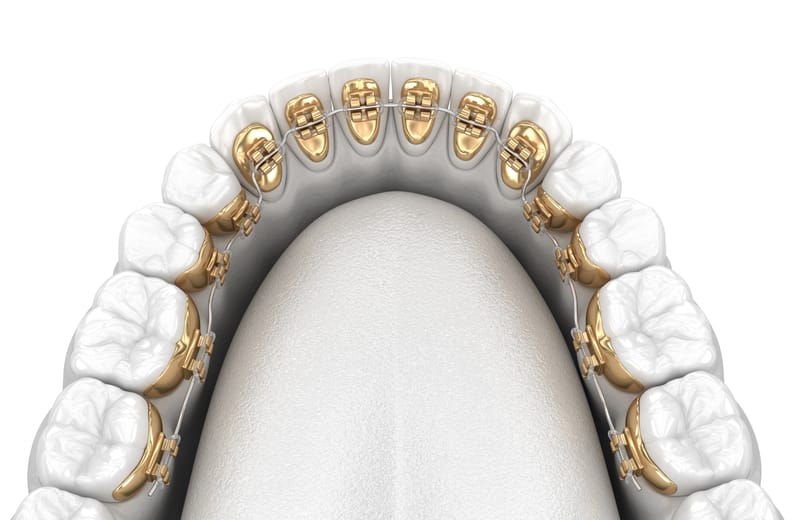 Lingual Braces