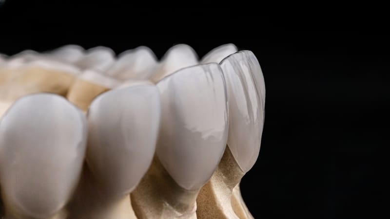 Zirconia Dental Bridges