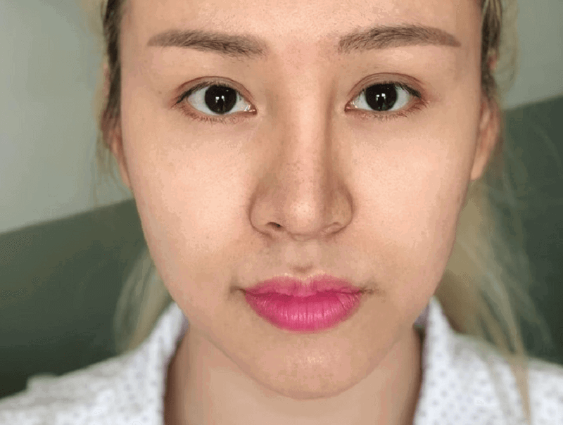 Nâng mũi bị hơi lệch phải làm sao?