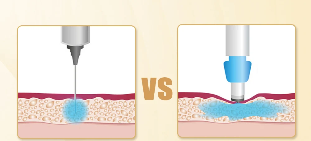 Needle Injection VS Hyaluron Pen