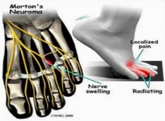 Mortons neuralgie