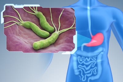 healing stomach ulcers with mother nature's products