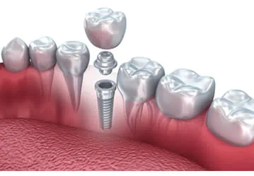 Implantologia Dentale