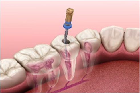 ENDODONCIA