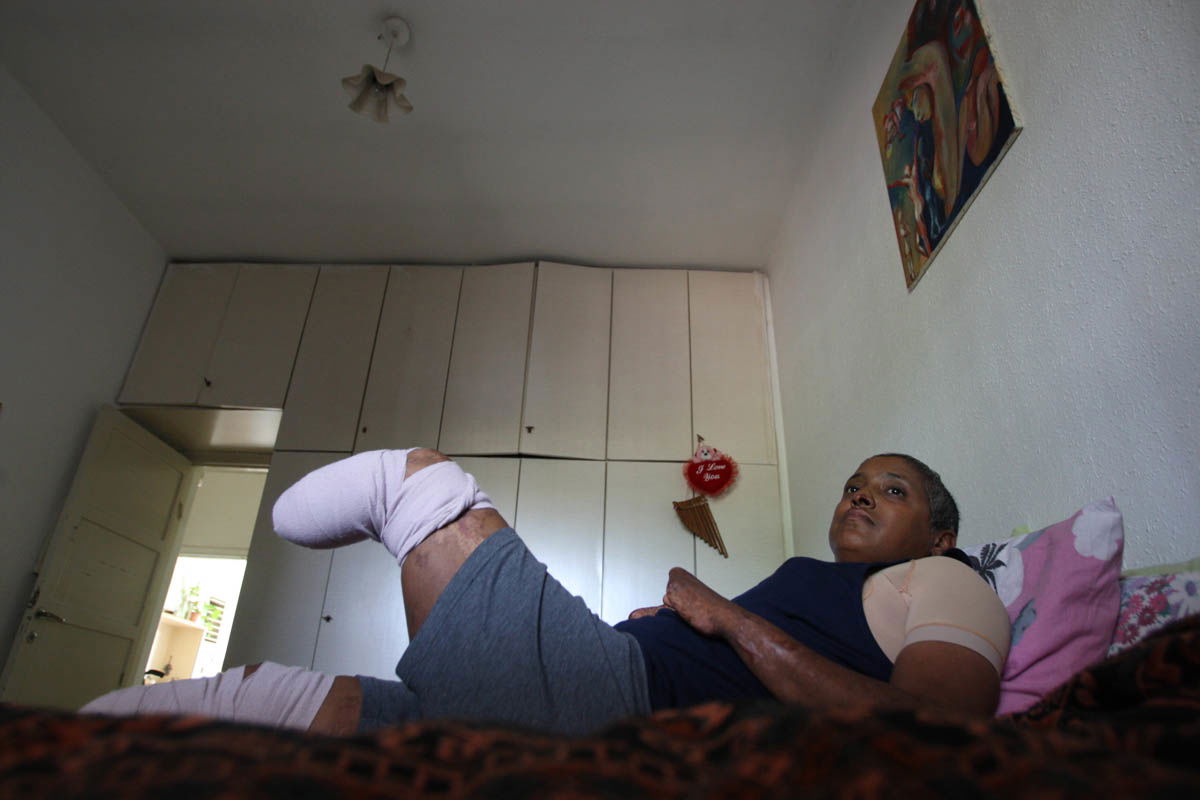 פנינה פייביש, עקיצת טפיל נדיר גרמה לגדיעת שתי רגליה ומספר אצבעות | Pnina Faibish, A rare parasite attack caused her to loss both legs and a few fingers