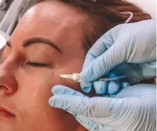 KARBOKSYTERAPIA POD OCZY