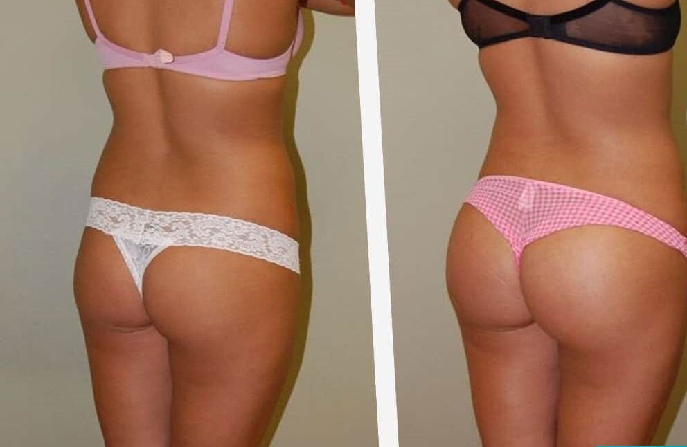 Buttock Aesthetic