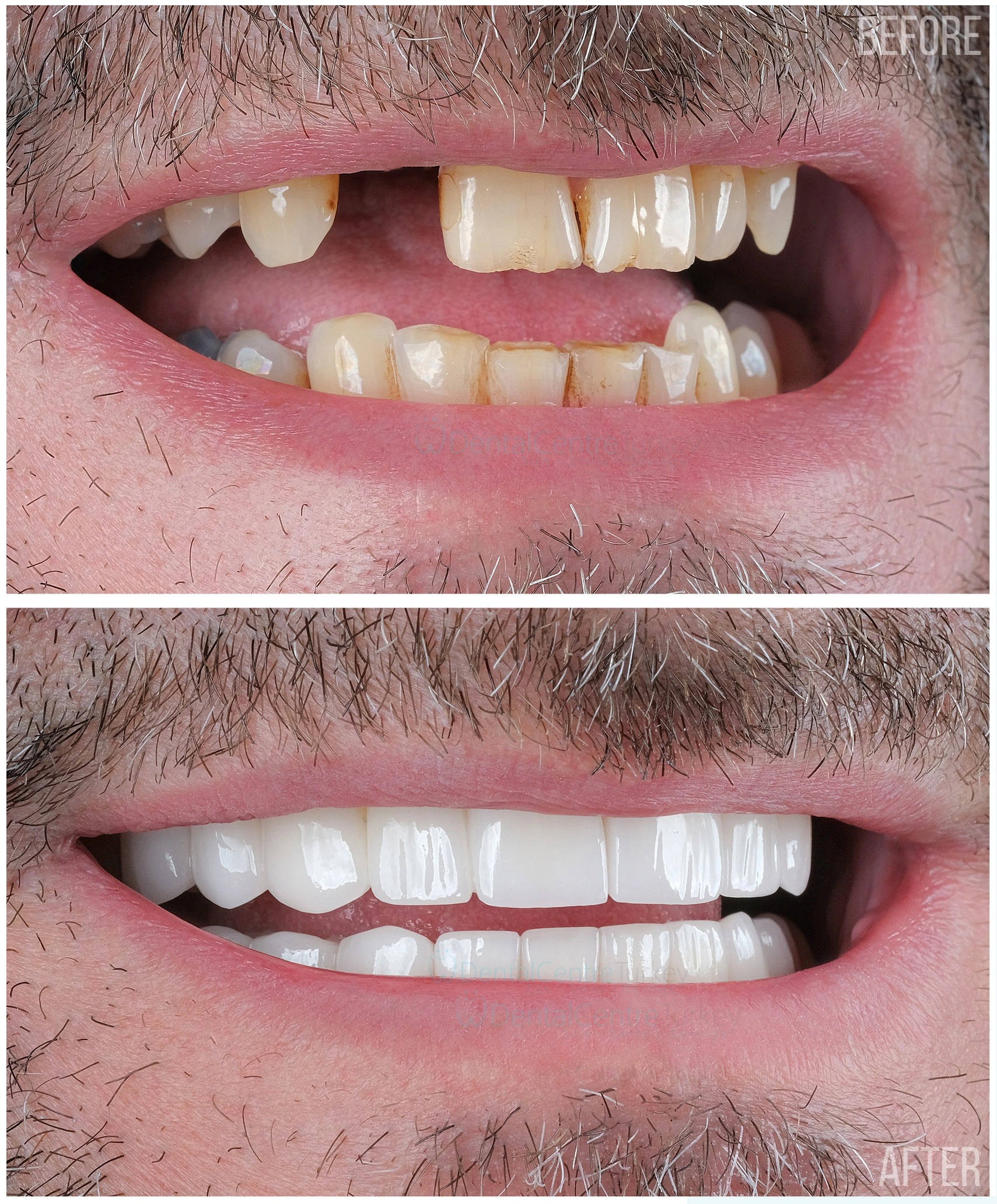 Porcelain Fillings & Implant