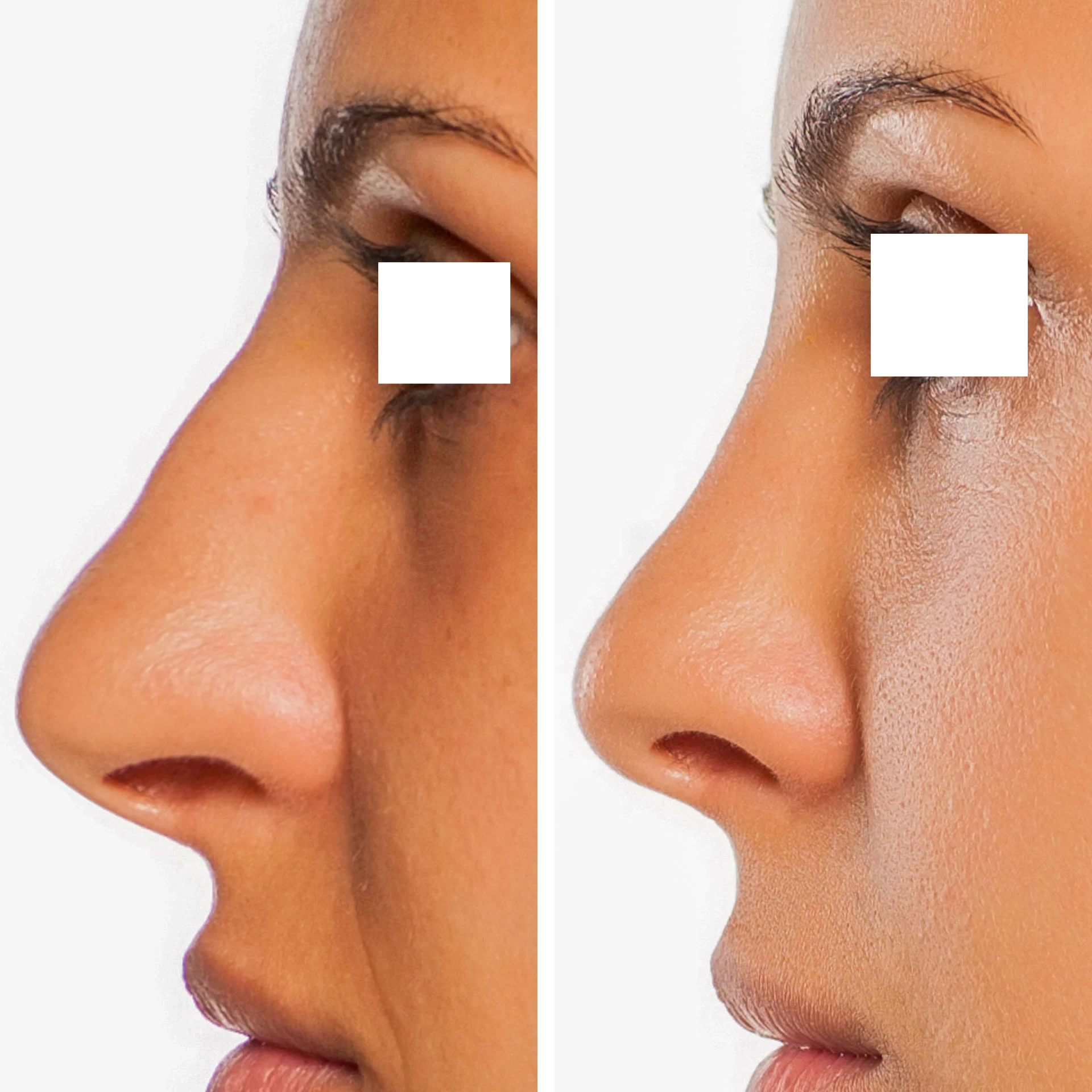 Rhinoplasty