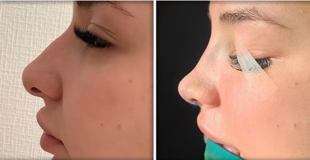 Rhinoplasty