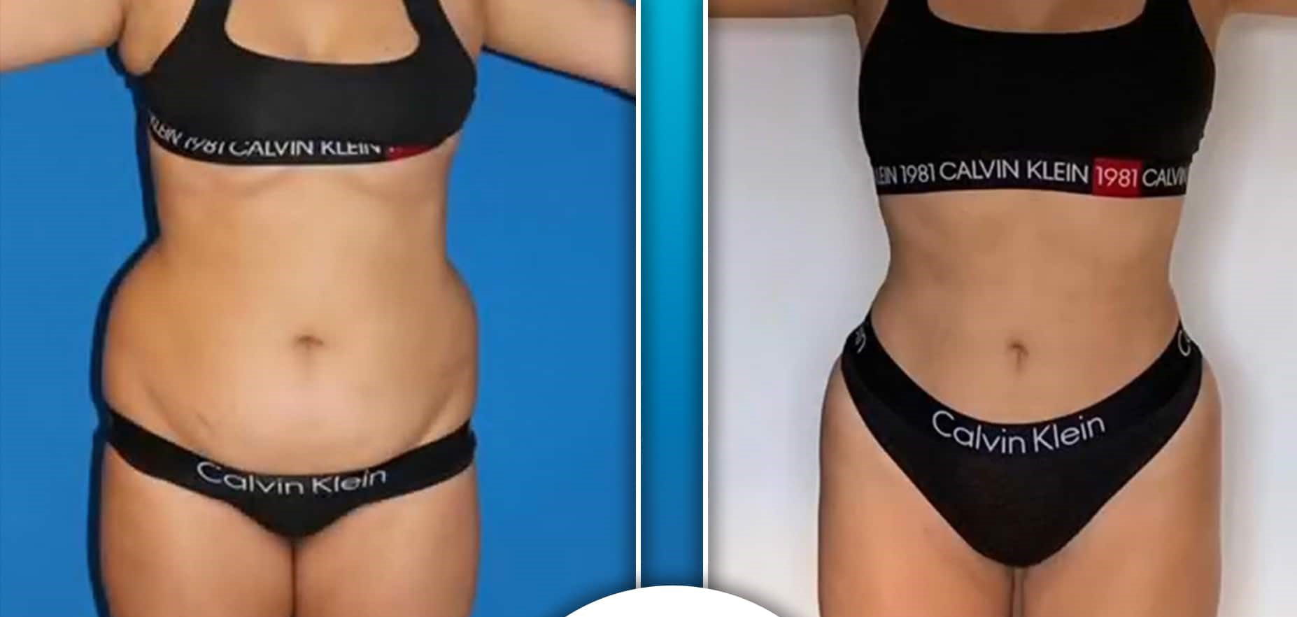 Microcannula Vase Liposuction
