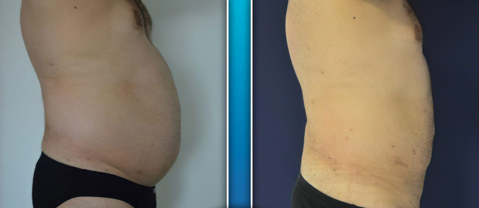 Microcannula Vase Liposuction