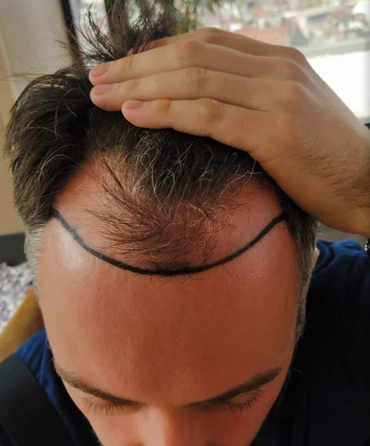 DHI Hair Implant
