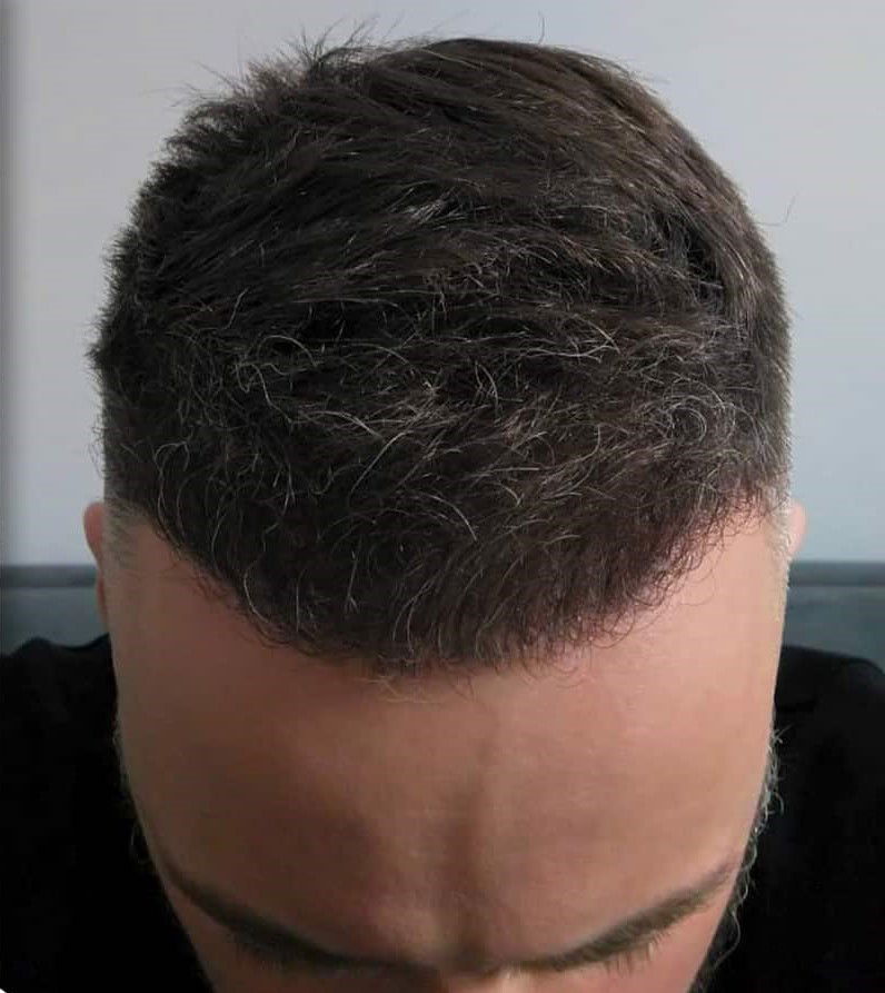 DHI Hair Implant