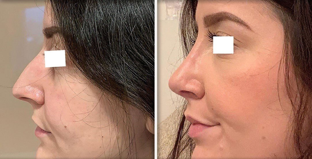 Rhinoplasty