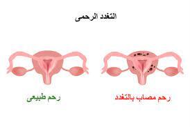 التغدد الرحمي