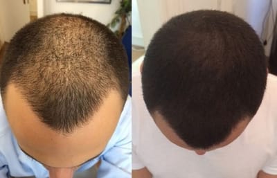 Top 10 Hair Transplant Surgeons India