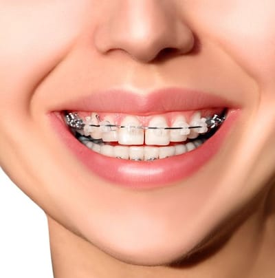 Best Braces Treatment Gurgaon
