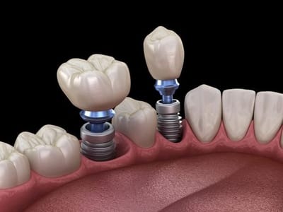 Top 10 Dental Implant Clinics Near Me