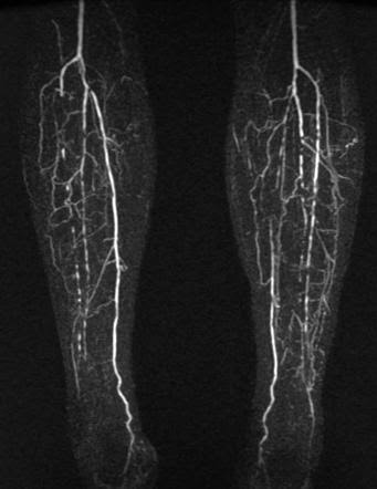 Peripheral Vascular Disease