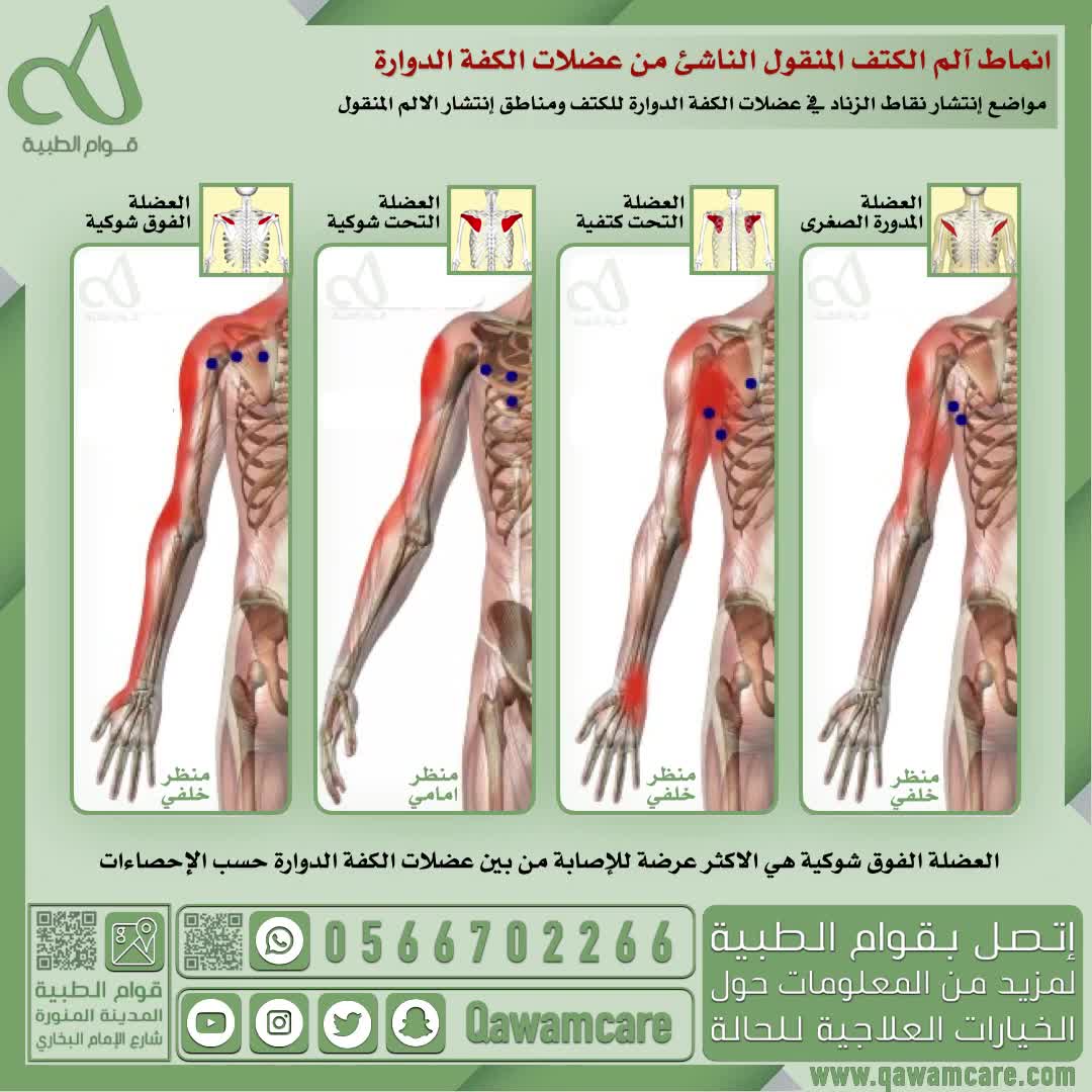 انماط آلم الكتف المنقول الناشئ من عضلات الكفة الدوارة 