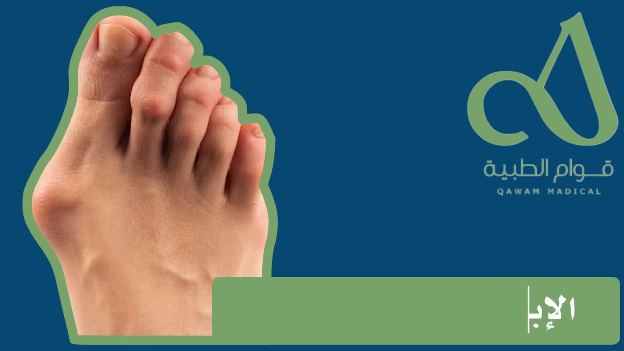 الوكعة إنحراف إصبع / إبهام القدم
