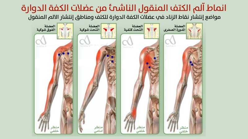انماط آلم الكتف المنقول الناشئ من عضلات الكفة الدوارة