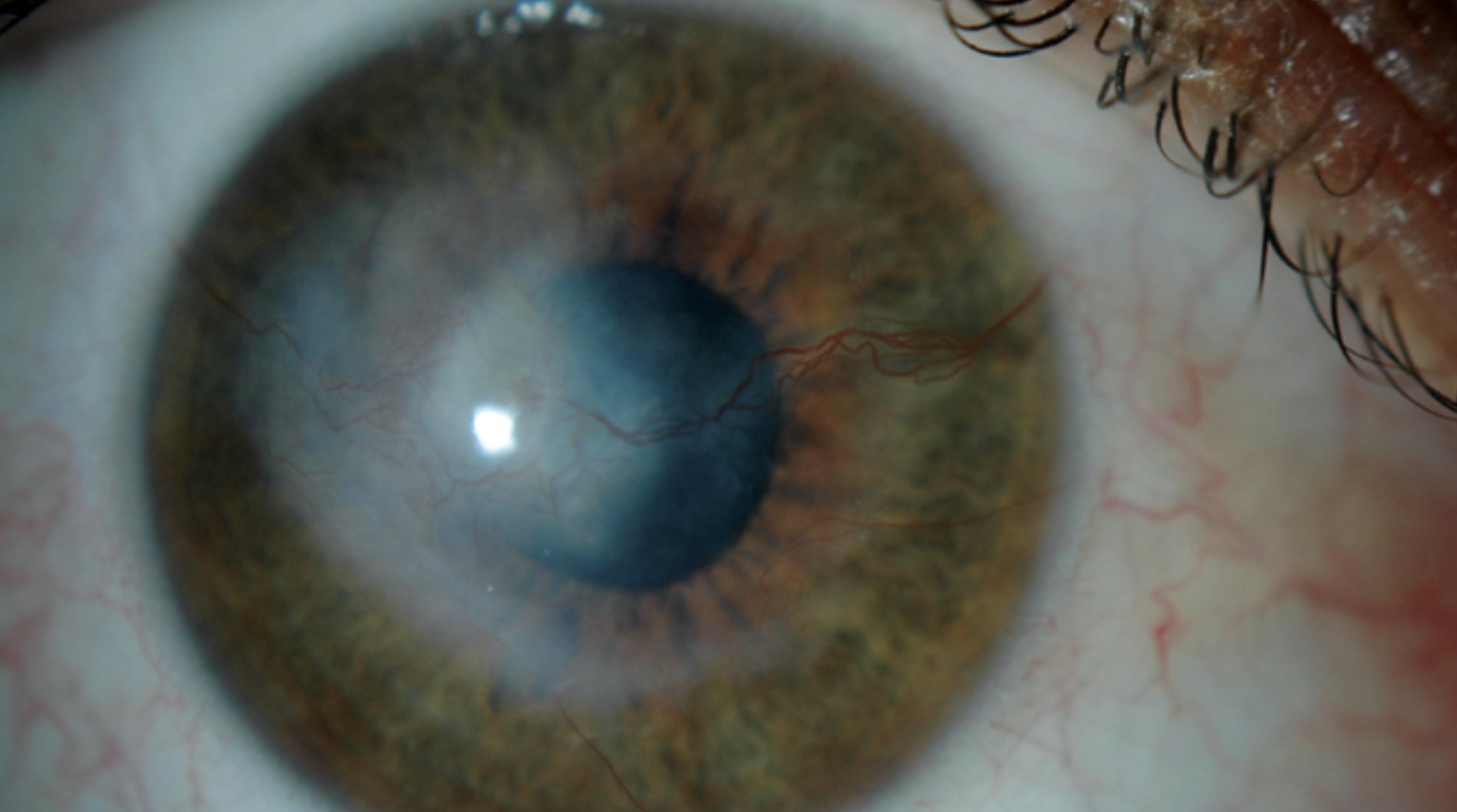 CAUSAS y SÍNTOMAS DE LA QUERATITIS