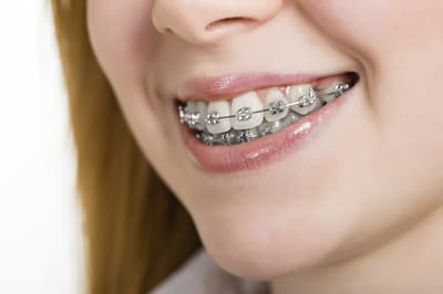 Getting Braces for Your Teeth image