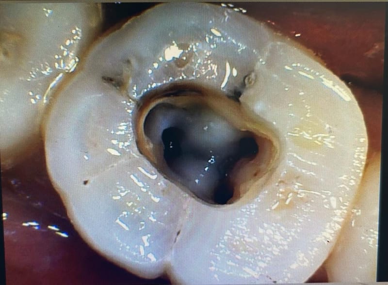 Root Canal Treatment