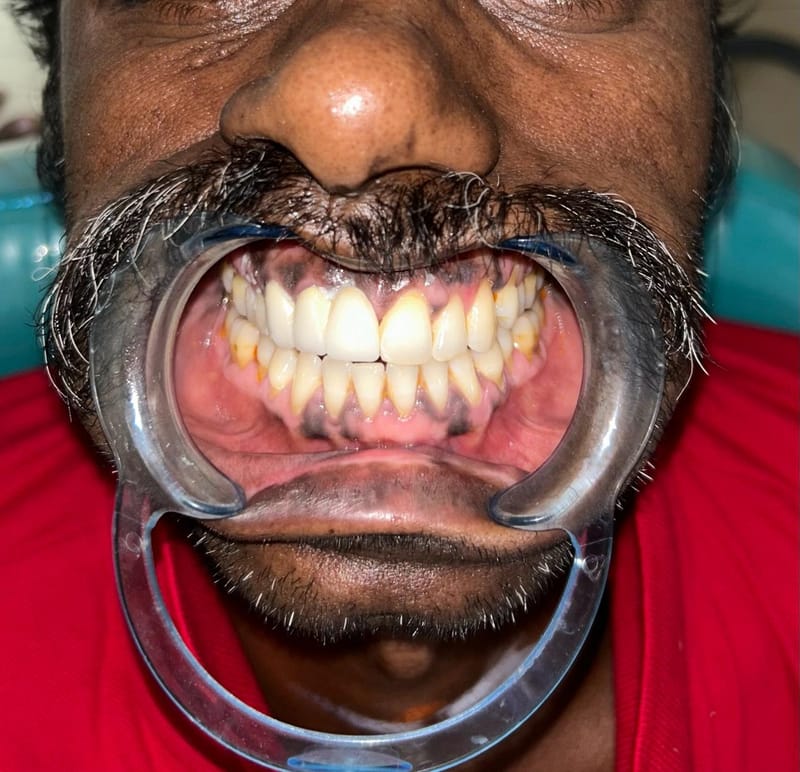 Aesthetic Crowns and Bridges