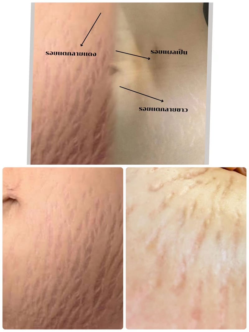 ฝังสีรอยเเตกลายทั่วไป เเก้ไขปัญหารอยเเตกลาย