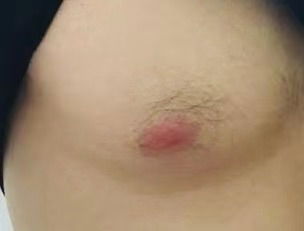 การฝังสีลานนม-สักหัวนม