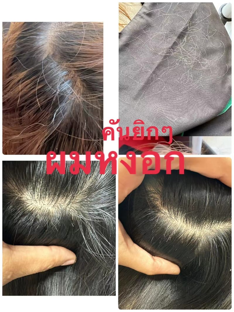 คันยิกๆ-ถอนผมหงอกผมคัน