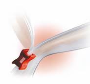 זיפרים לפתיחה חוזרת