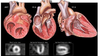Myocardial Perfusion Imaging