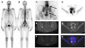 Bone Scintigraphy