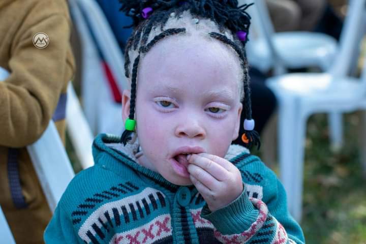 Advocacy Efforts For Albinism