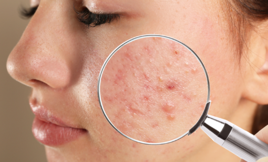 Tratamento para Acne
